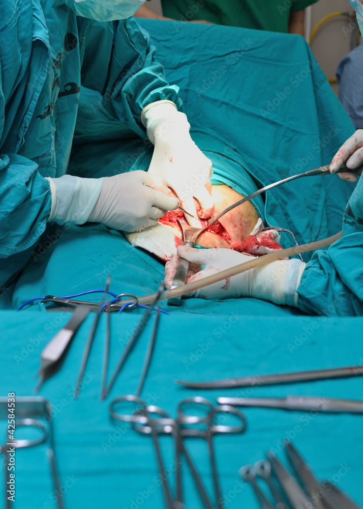 cesarean section cesarean section