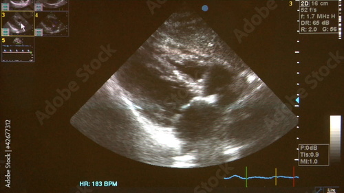ultrasound scan of childs heart