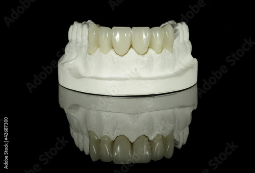 Crown Bridge on Dental Model