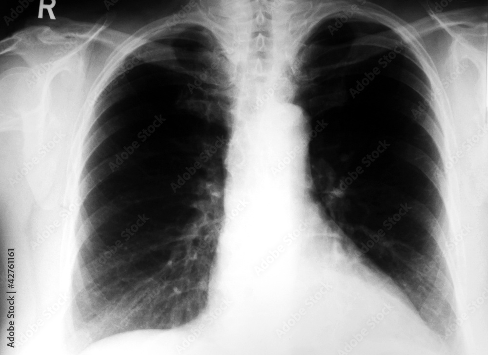 Lung xray Lung xray