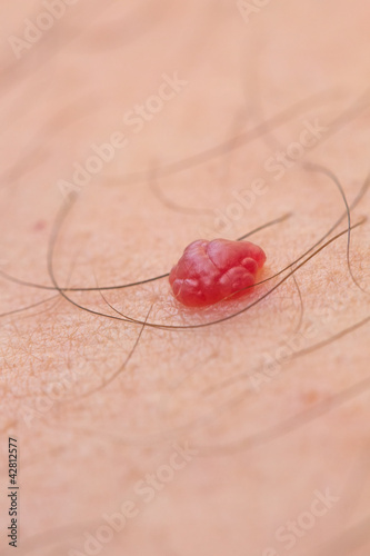 Photography senile angioma