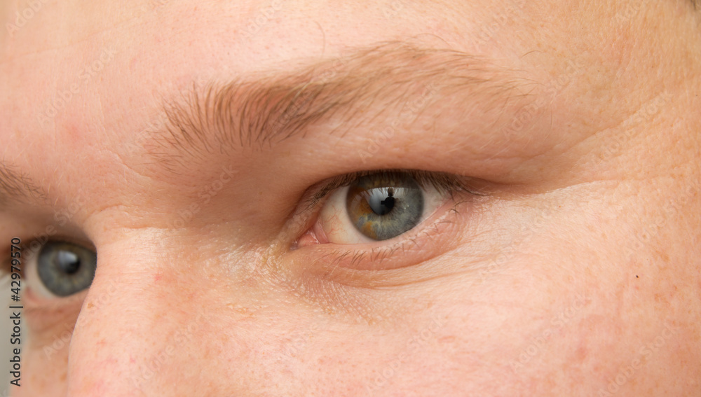 eye with a birthmark eye with a birthmark