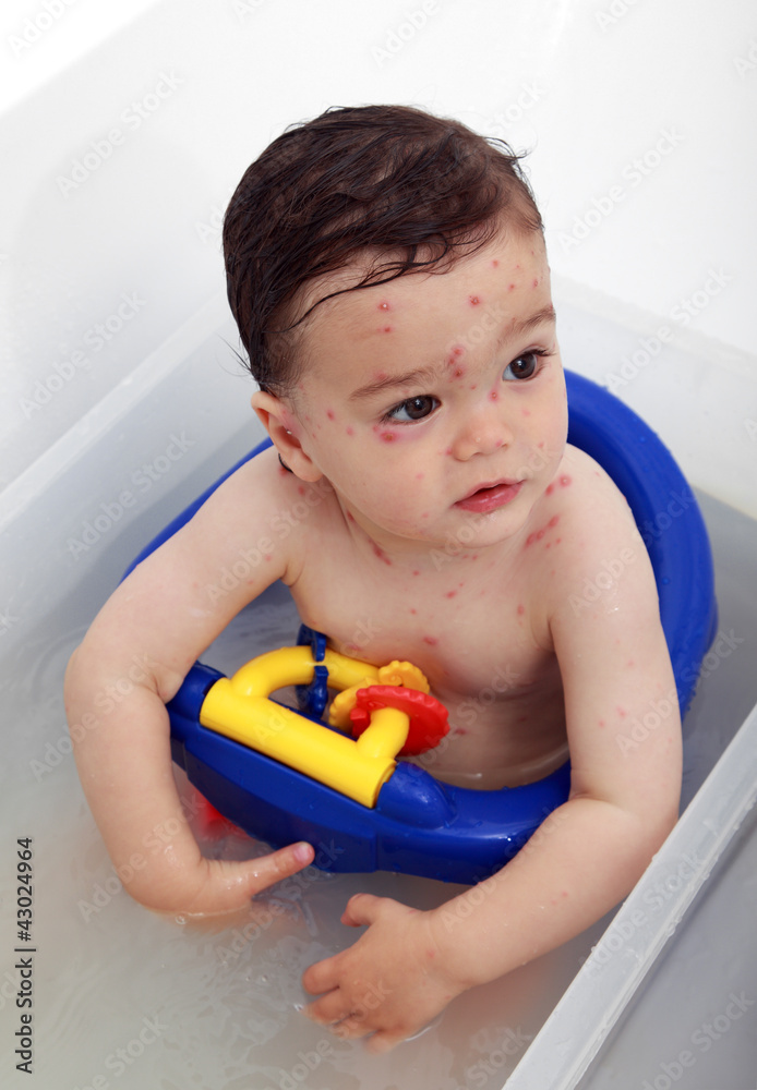 Baby suffering with chickenpox having bath Baby suffering with chickenpox having bath