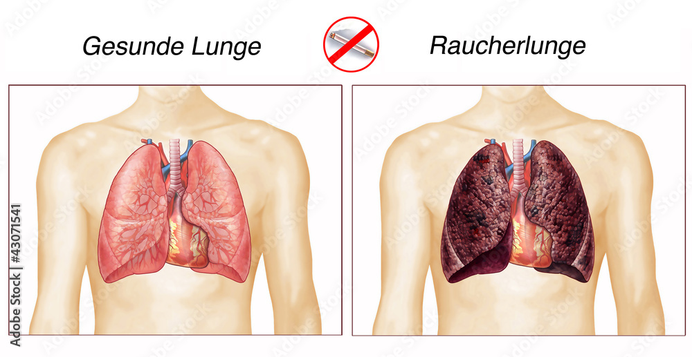 Gesunde Lunge.Raucherlunge.Brustkorb mit Lunge Stock Illustration | Adobe  Stock