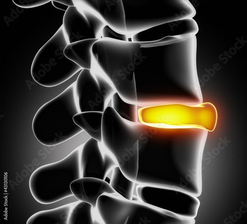 Disc ruptured in x-ray view - close up
