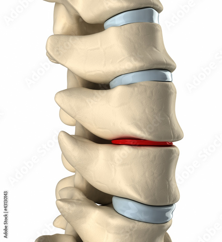 Thinning disc deformation