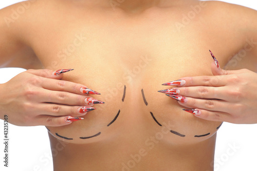 Closeup photo of a Caucasian woman's breasts marked