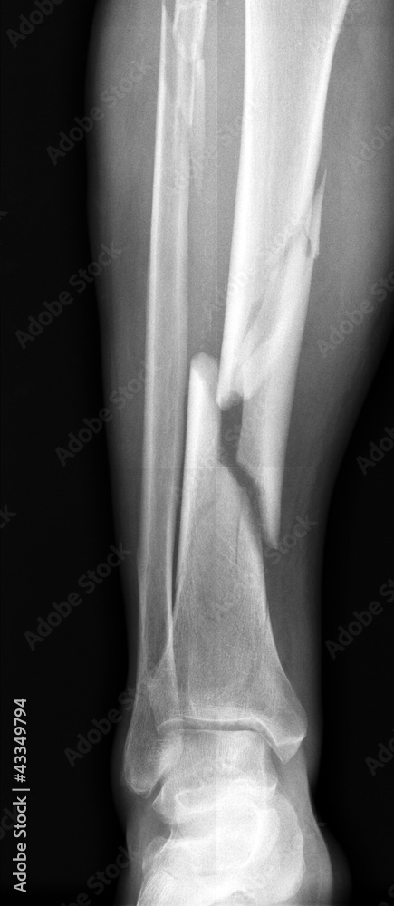 X-ray of broken leg. Photos | Adobe Stock