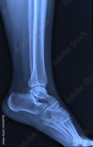 Obraz na płótnie X-ray ankle joint. w salonie