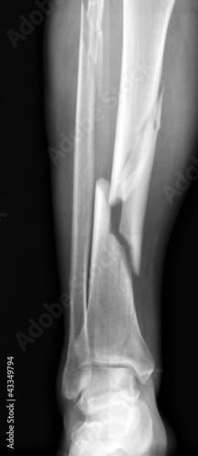 Obraz na płótnie X-ray of broken leg. w salonie