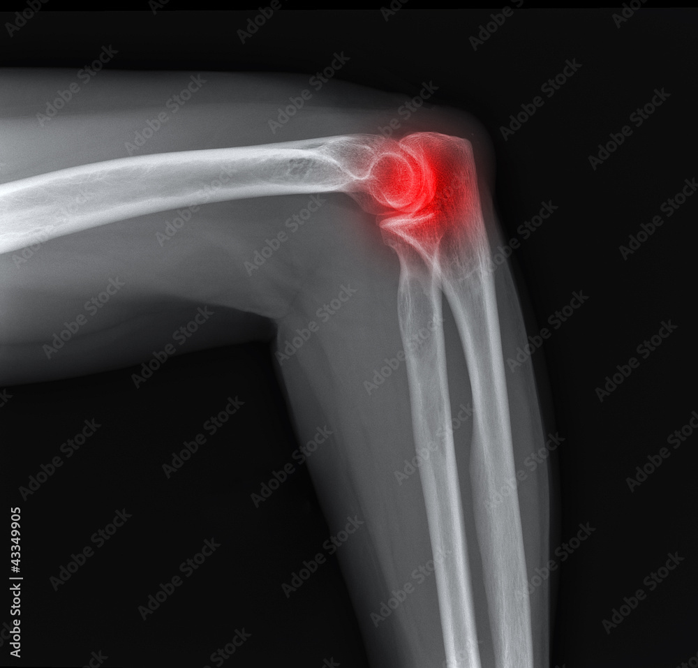 X-ray of the painful elbow joint.