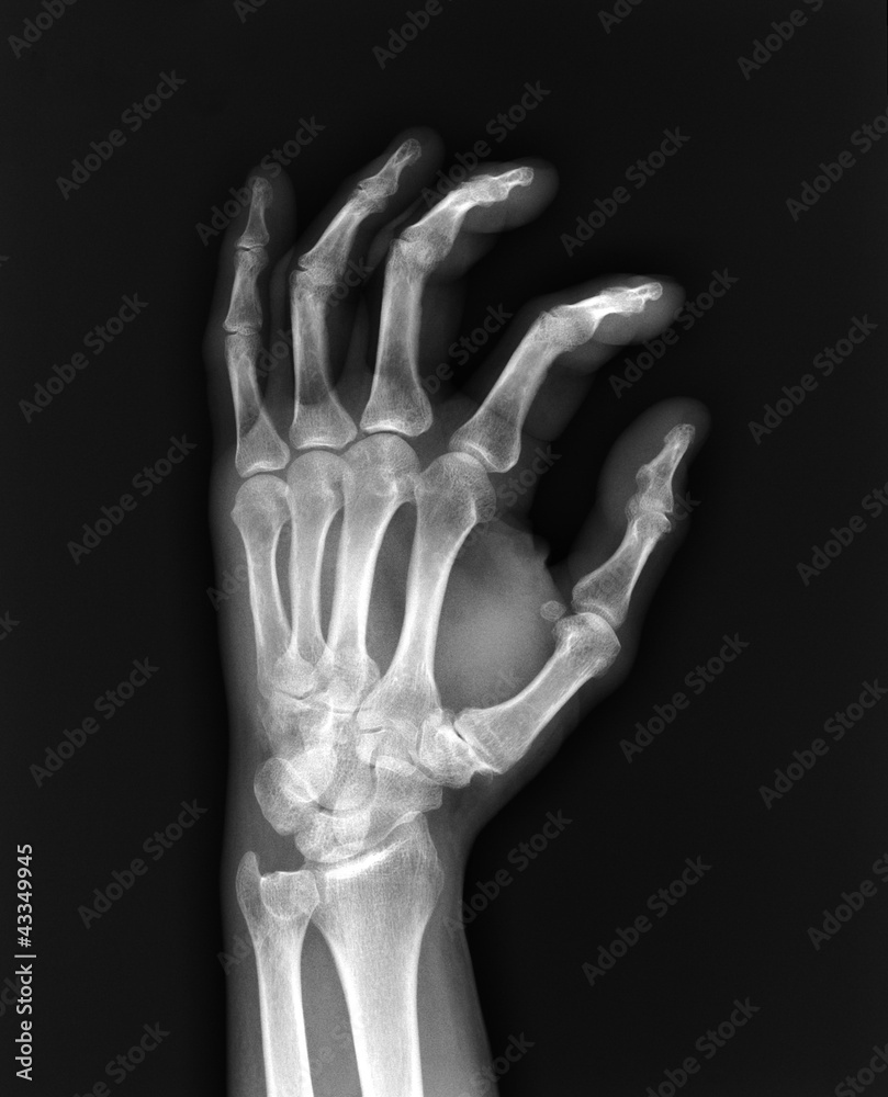 X-ray hand