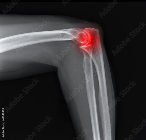 Obraz na płótnie X-ray of the painful elbow joint. w salonie