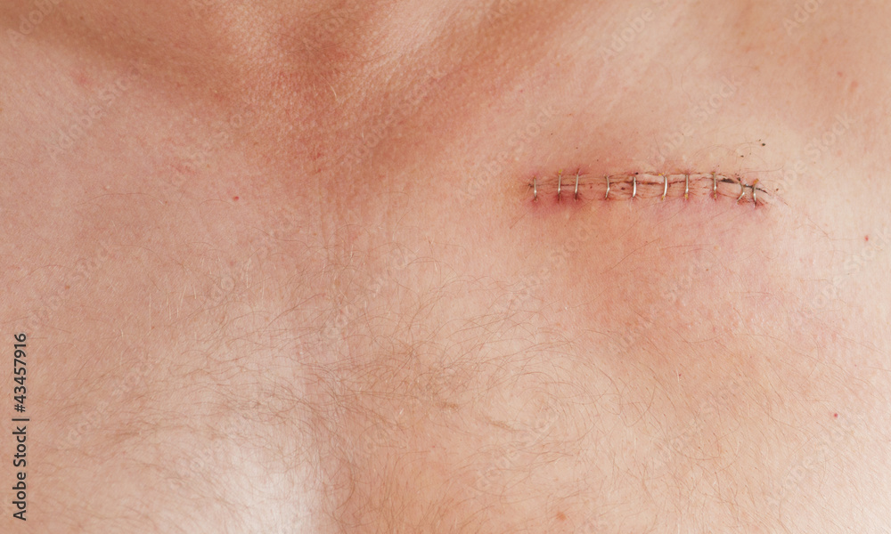 pacemaker scar