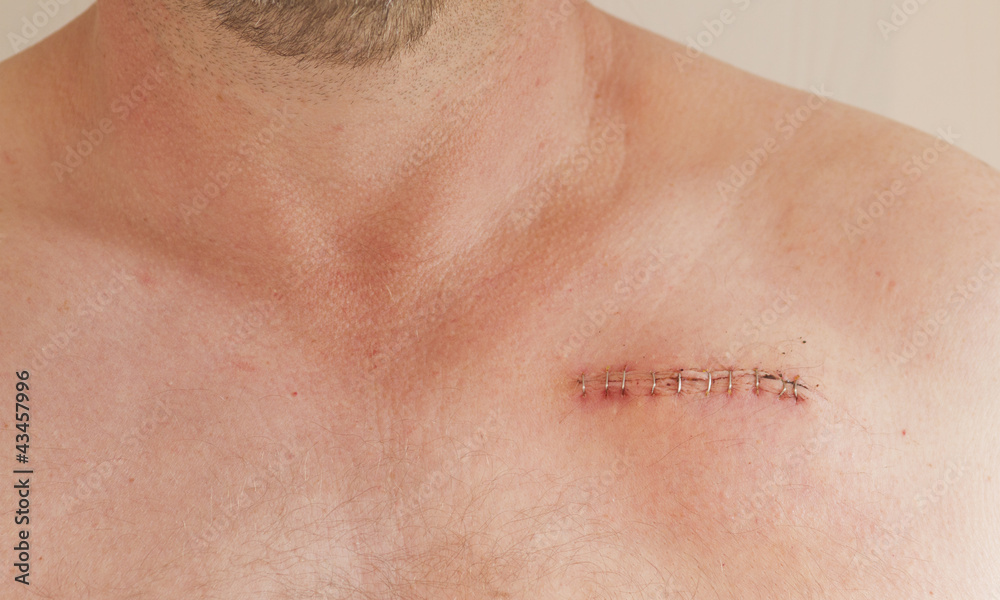 pacemaker scar