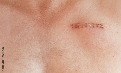 Foto pacemaker scar
