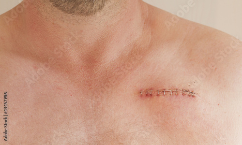 Photo pacemaker scar