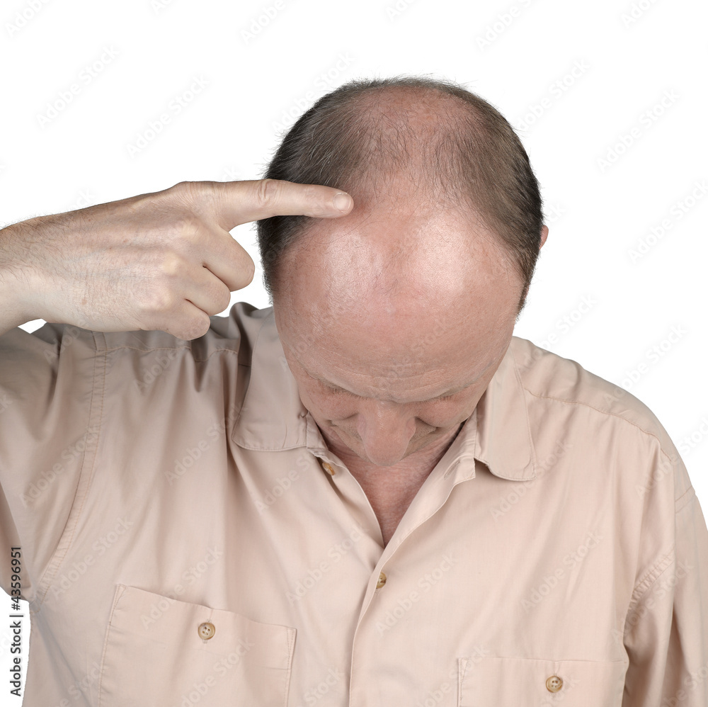 Human hair loss - adult man hand pointing his bald head Human hair loss - adult man hand pointing his bald head