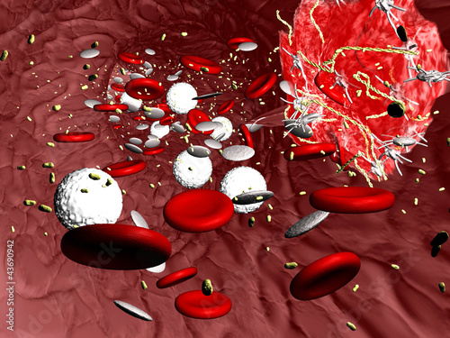 Billede på lærred Blood Vessel - Thrombus III
