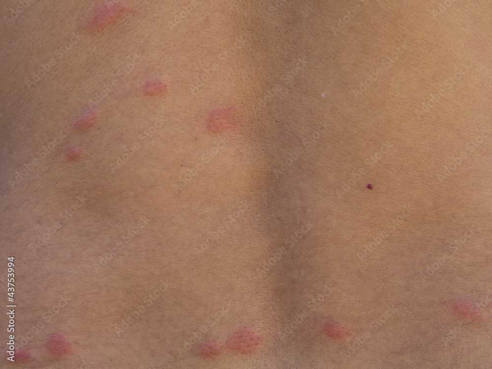Fototapeta premium flea bites