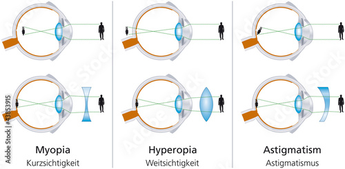 The visual defects Myopia, Hyperopia and Astigmatism and how to correct it with biconcave and biconvex lenses. With glasses or contact lenses. Illustration on white background. Vector.