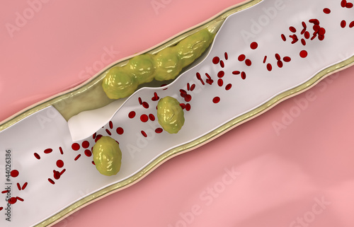 Coronary cholesterol  travels through the circulatory system photo
