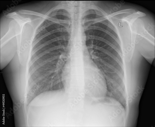 A chest x-ray image