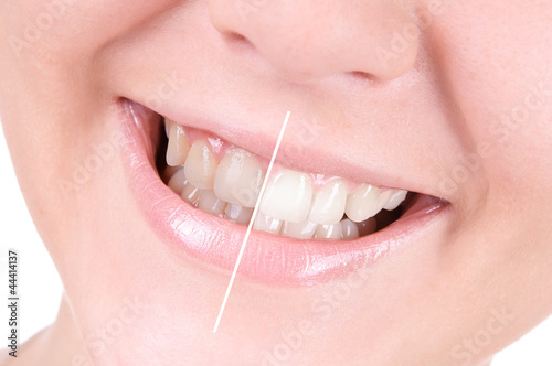 Teeth whitening. Dental care © inna_astakhova
