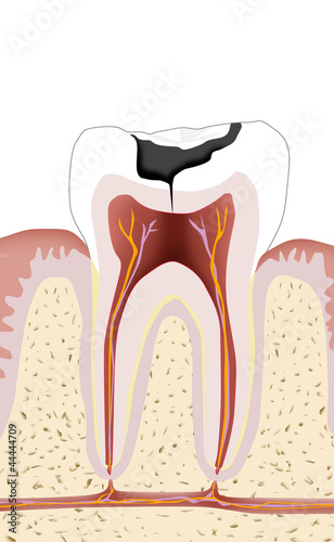 Zahn mit Karies, Endodontie 1 #44444709