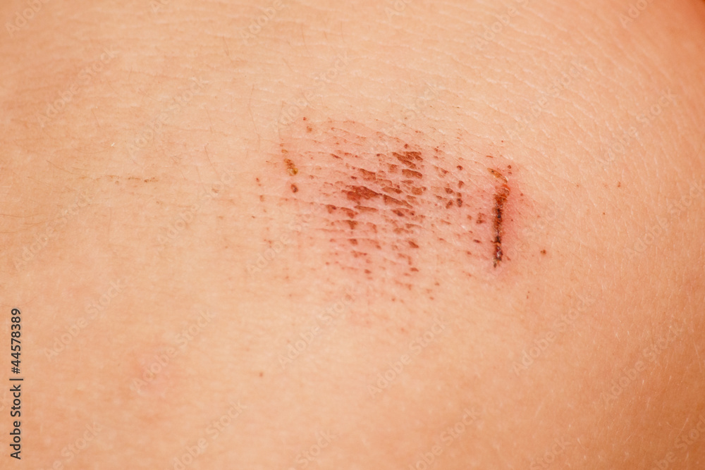 Fototapeta premium Schürfwunde