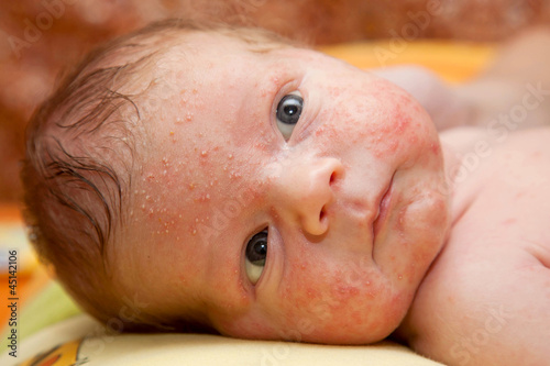 newborn baby. On  face rash, acne neonatorum photo