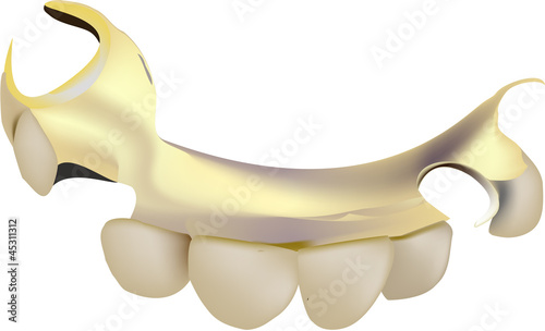dental prosthesis