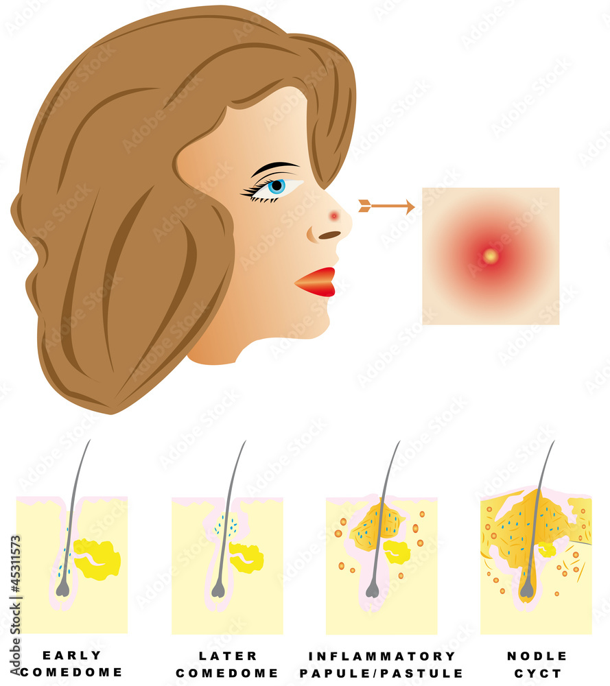 Acne is divided into four types Stock Vector | Adobe Stock