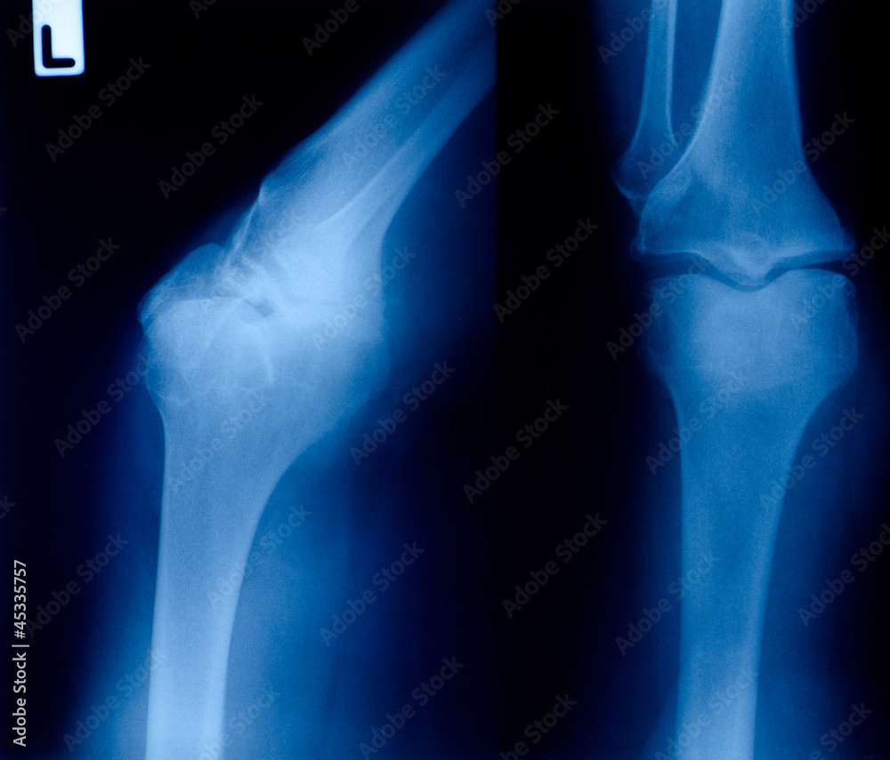 X ray film of knee fracture X ray film of knee fracture