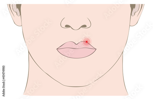 disease herpes virus on mouth
