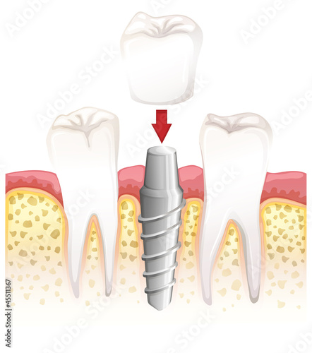 Dental crown procedure