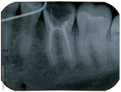 Dental X-Ray photo