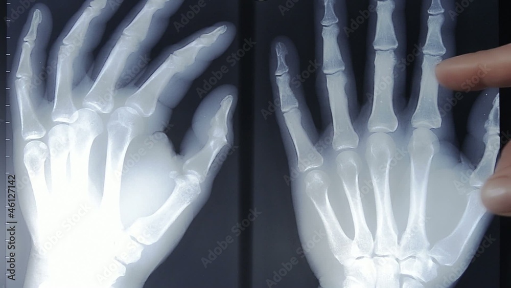 hand x-ray