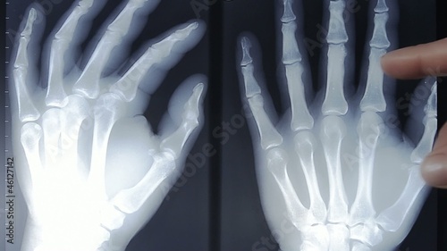 hand x-ray