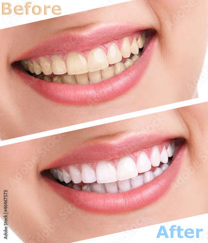 bleaching teeth treatment #46467573