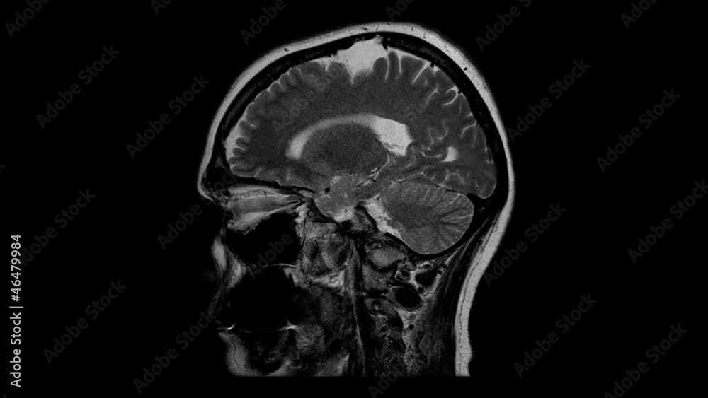 Computed tomography of the brain