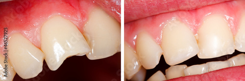 Fractured tooth (incisor) - part of Beforeafter series. photo