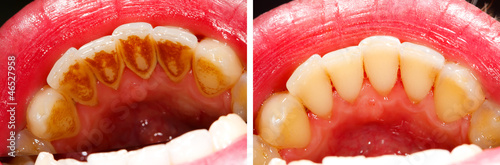 Before and after treatment - teeth