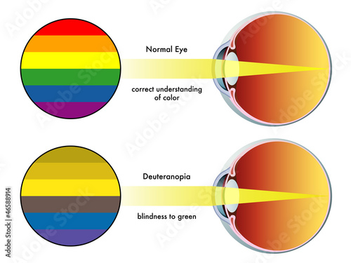 deuteranopia