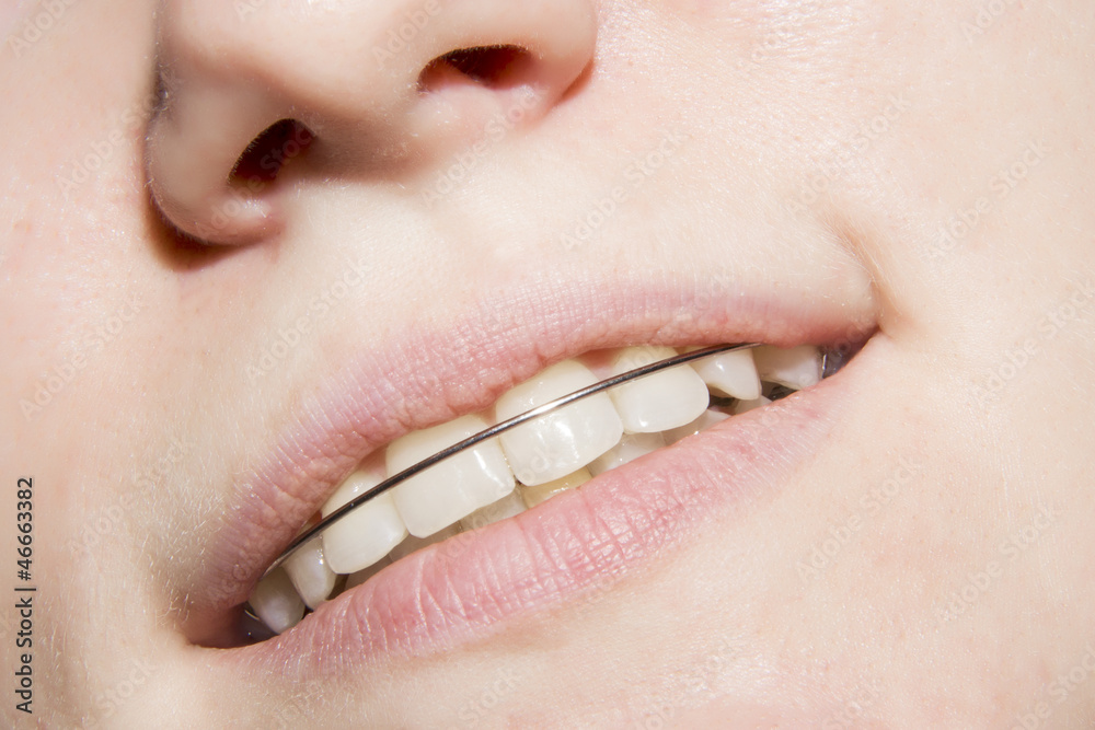 Fototapeta premium the young girl smiling with braces on teeth