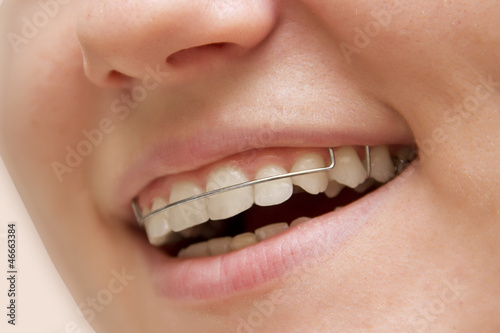 the young girl smiling with braces on teeth