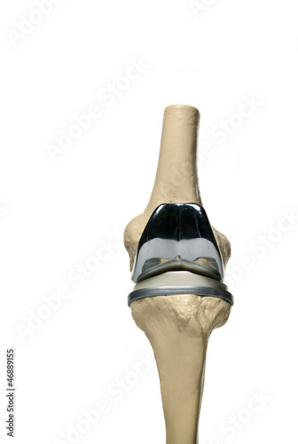 picture of an anatomic study model of an knee replacement