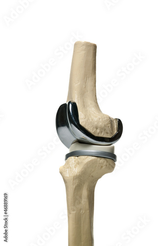 picture of an anatomic study model of an knee replacement