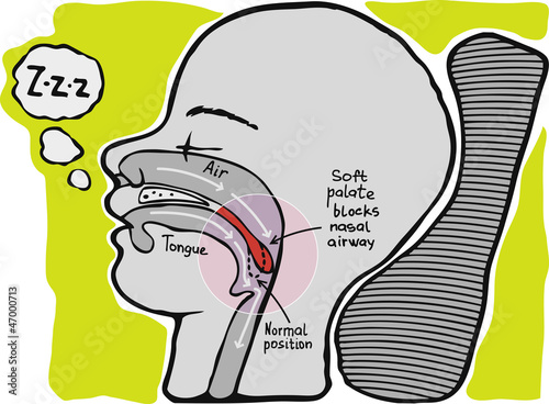 Snoring. Informational graphics, vector