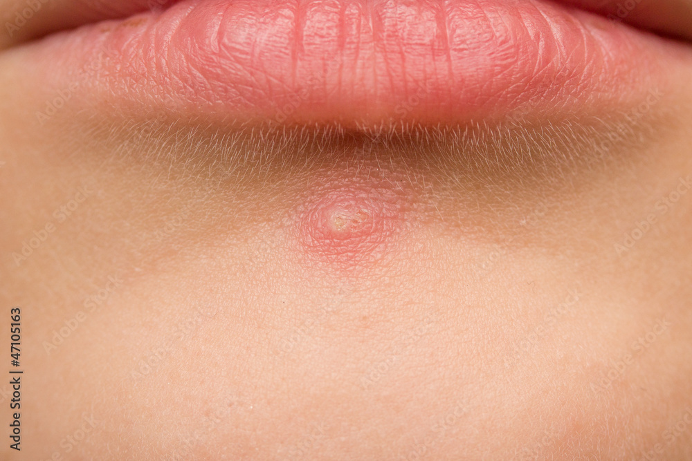 Fototapeta premium Pimple on a girls chin